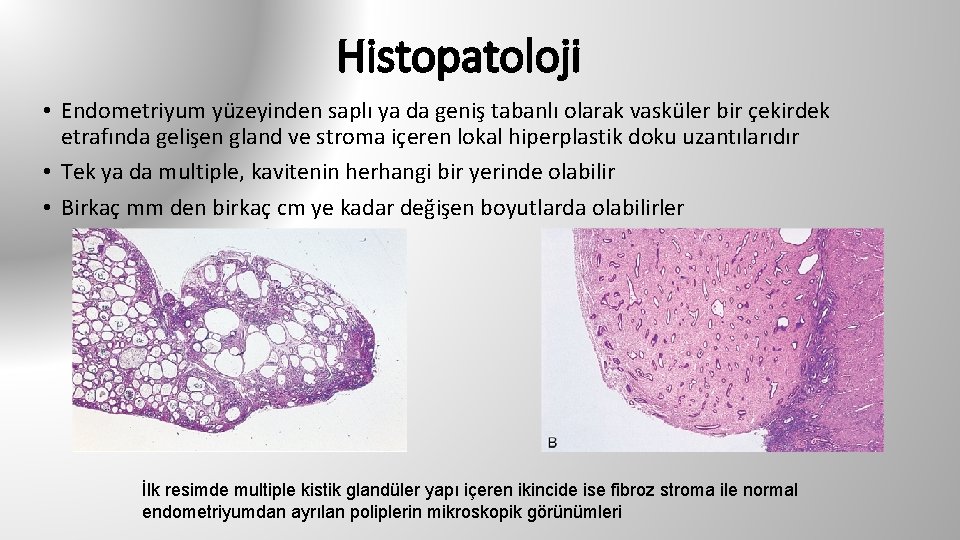 Histopatoloji • Endometriyum yüzeyinden saplı ya da geniş tabanlı olarak vasküler bir çekirdek etrafında