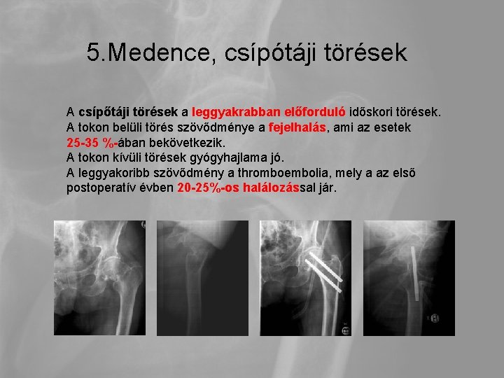5. Medence, csípótáji törések A csípőtáji törések a leggyakrabban előforduló időskori törések. A tokon