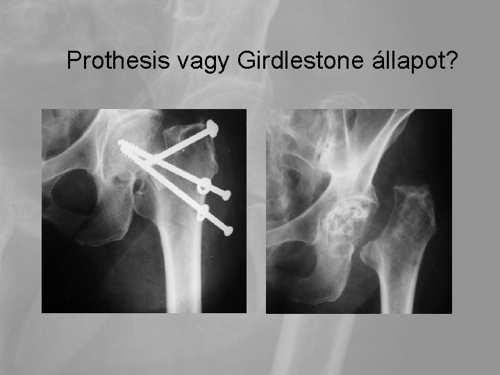 Prothesis vagy Girdlestone állapot? 
