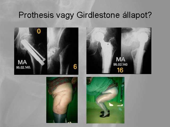 Prothesis vagy Girdlestone állapot? 