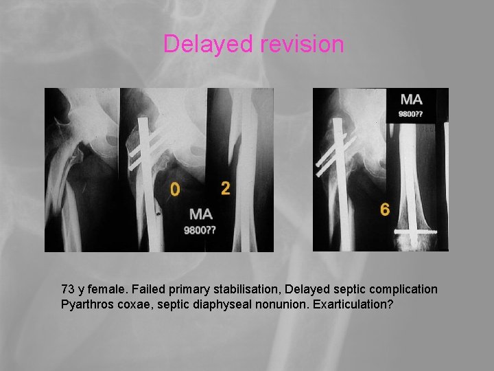 Delayed revision 73 y female. Failed primary stabilisation, Delayed septic complication Pyarthros coxae, septic