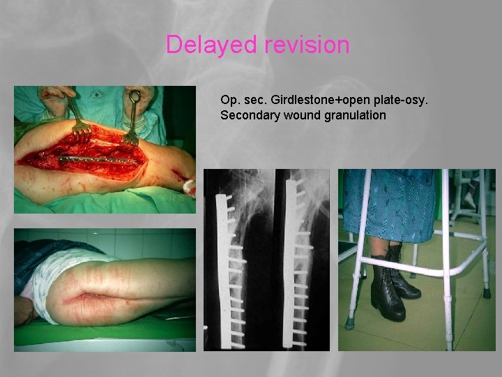 Delayed revision Op. sec. Girdlestone+open plate-osy. Secondary wound granulation 