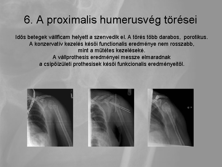 6. A proximalis humerusvég törései Idős betegek vállficam helyett a szenvedik el. A törés