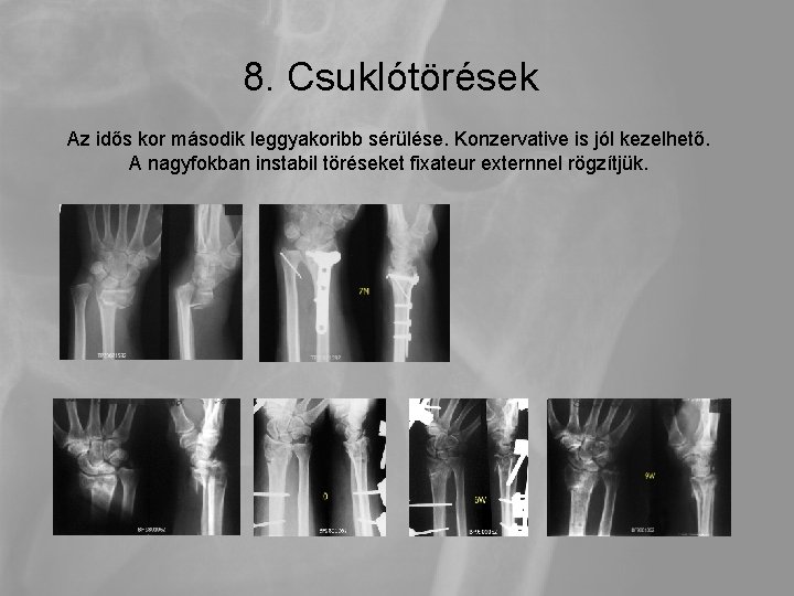 8. Csuklótörések Az idős kor második leggyakoribb sérülése. Konzervative is jól kezelhető. A nagyfokban