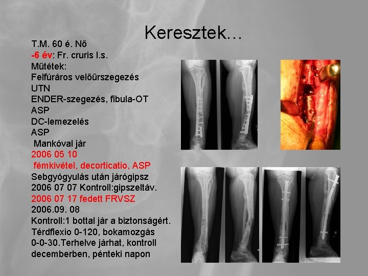 Keresztek… T. M. 60 é. Nő -6 év: Fr. cruris l. s. Műtétek: Felfúráros