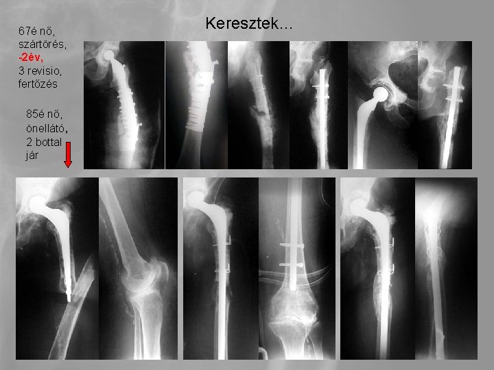 67é nő, szártörés, -2év, 3 revisio, fertőzés 85é nő, önellátó, 2 bottal jár Keresztek…