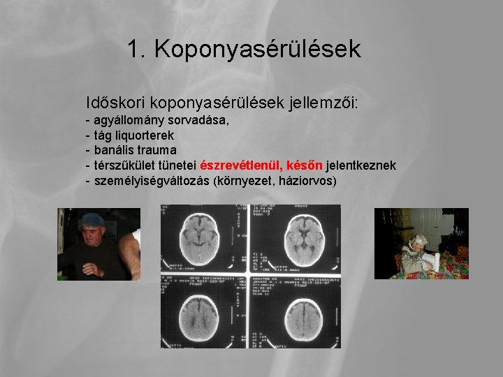 1. Koponyasérülések Időskori koponyasérülések jellemzői: - agyállomány sorvadása, - tág liquorterek - banális trauma