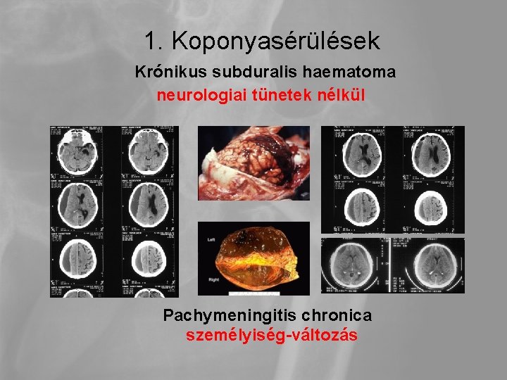 1. Koponyasérülések Krónikus subduralis haematoma neurologiai tünetek nélkül Pachymeningitis chronica személyiség-változás 