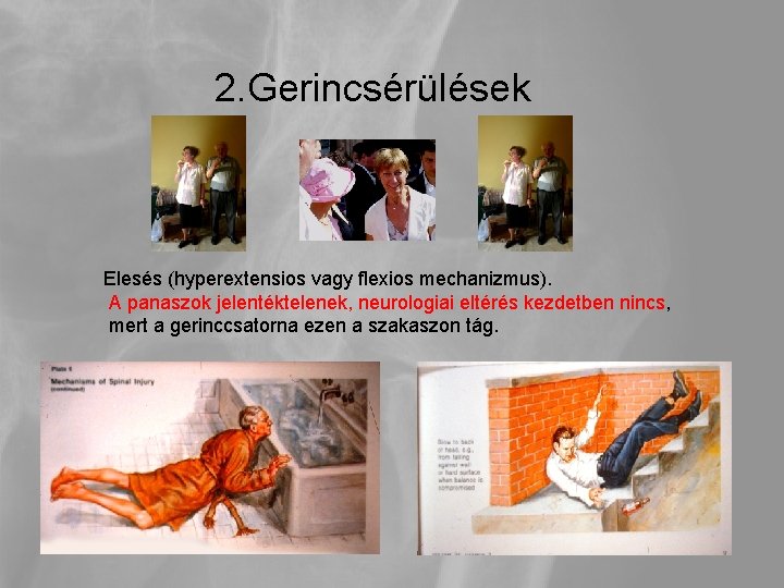 2. Gerincsérülések Elesés (hyperextensios vagy flexios mechanizmus). A panaszok jelentéktelenek, neurologiai eltérés kezdetben nincs,