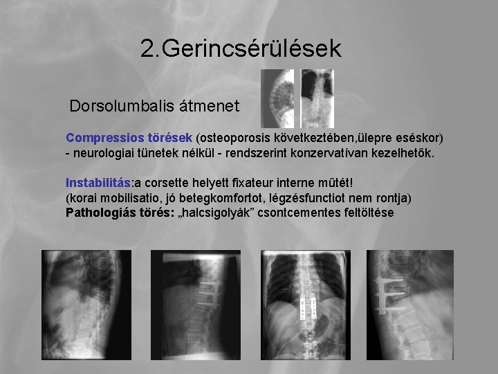 2. Gerincsérülések Dorsolumbalis átmenet Compressios törések (osteoporosis következtében, ülepre eséskor) - neurologiai tünetek nélkül