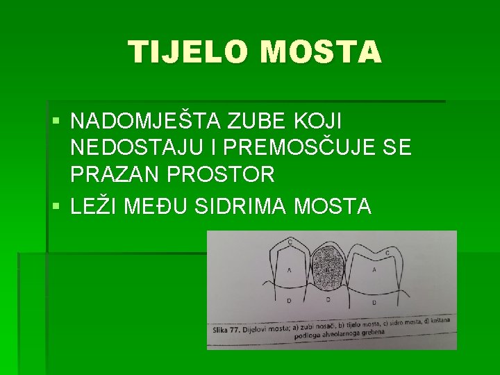 TIJELO MOSTA § NADOMJEŠTA ZUBE KOJI NEDOSTAJU I PREMOSČUJE SE PRAZAN PROSTOR § LEŽI