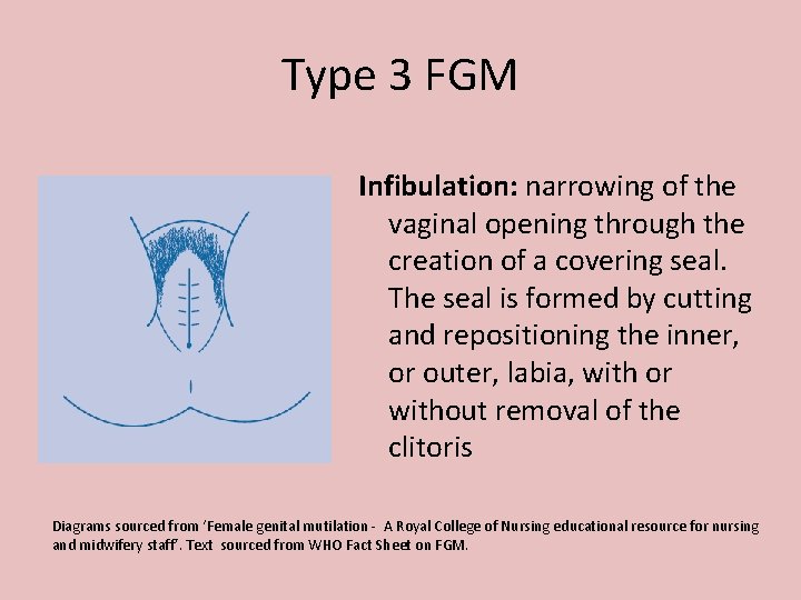 Type 3 FGM Infibulation: narrowing of the vaginal opening through the creation of a
