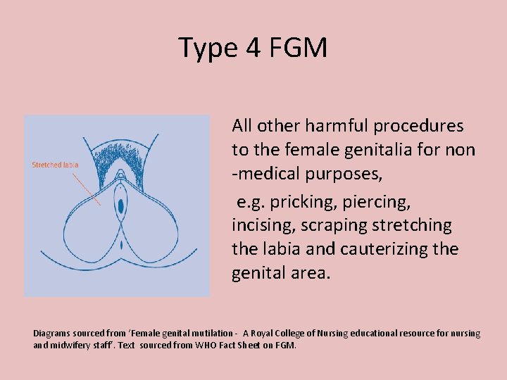 Type 4 FGM All other harmful procedures to the female genitalia for non -medical