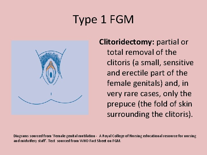 Type 1 FGM Clitoridectomy: partial or total removal of the clitoris (a small, sensitive