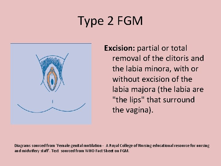 Type 2 FGM Excision: partial or total removal of the clitoris and the labia