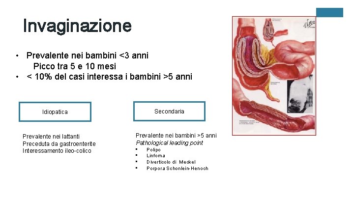 Invaginazione • Prevalente nei bambini <3 anni Picco tra 5 e 10 mesi •