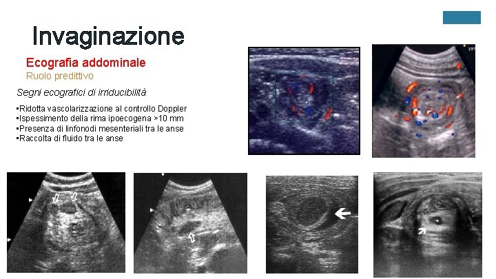 Invaginazione Ecografia addominale Ruolo predittivo Segni ecografici di irriducibilità • Ridotta vascolarizzazione al controllo