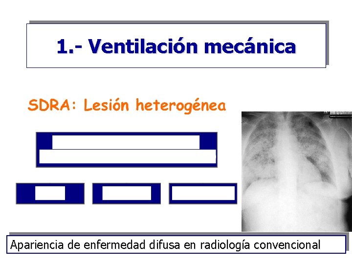 1. - Ventilación mecánica Apariencia de enfermedad difusa en radiología convencional 