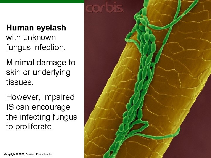 Human eyelash with unknown fungus infection. Minimal damage to skin or underlying tissues. However,