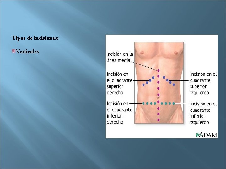 Tipos de incisiones: Verticales 