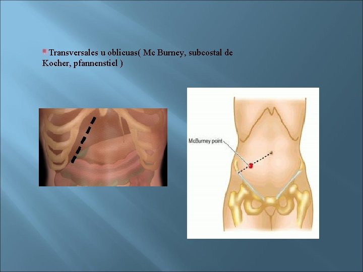 Transversales u oblicuas( Mc Burney, subcostal de Kocher, pfannenstiel ) 