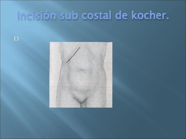 Incisión sub costal de kocher. � 