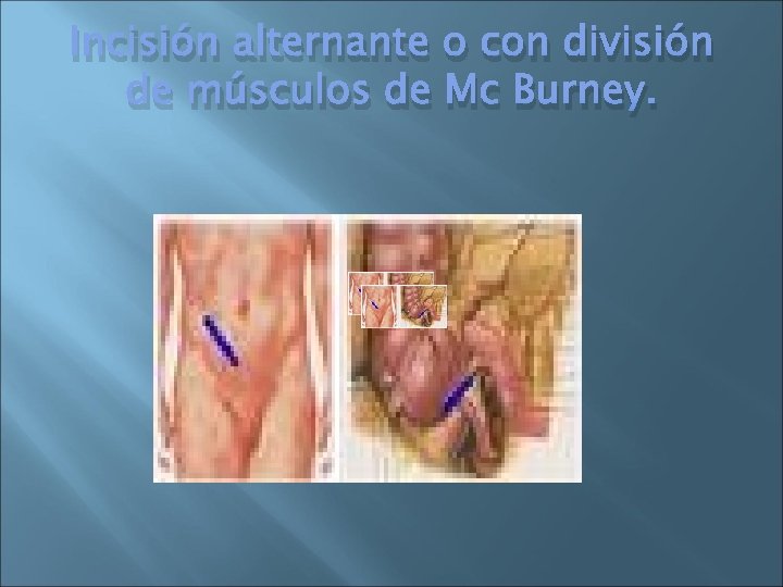 Incisión alternante o con división de músculos de Mc Burney. 