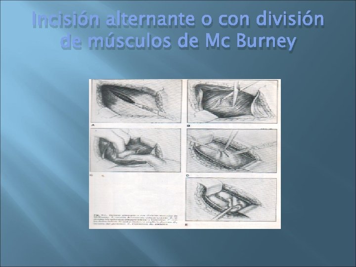 Incisión alternante o con división de músculos de Mc Burney 
