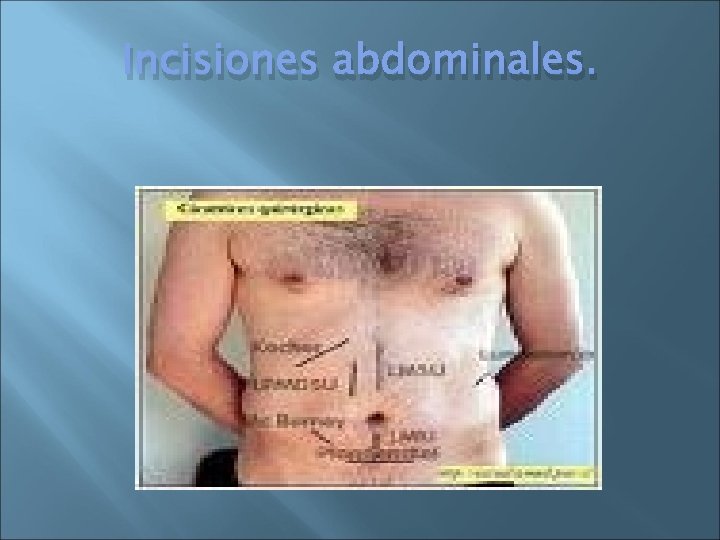 Incisiones abdominales. 