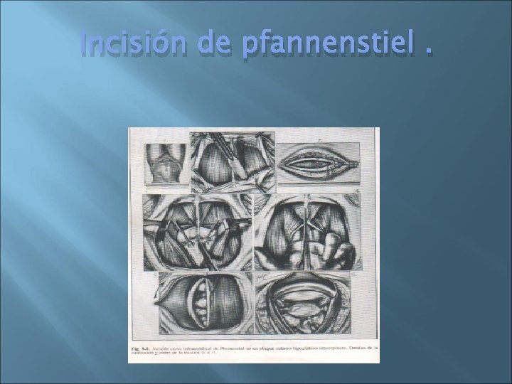 Incisión de pfannenstiel. 