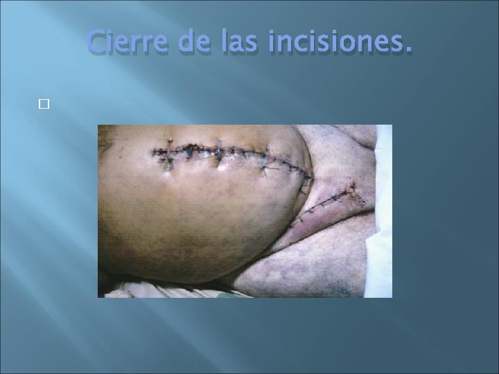 Cierre de las incisiones. � 