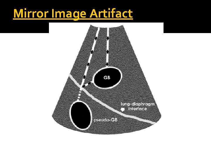 Mirror Image Artifact 