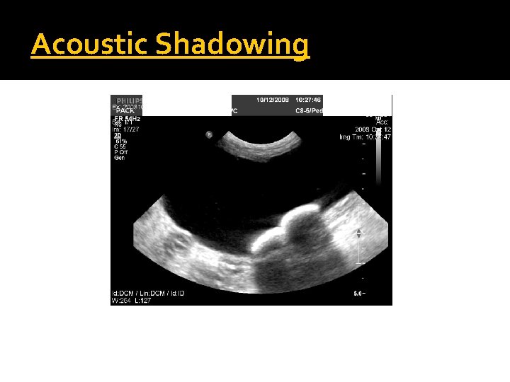 Acoustic Shadowing 