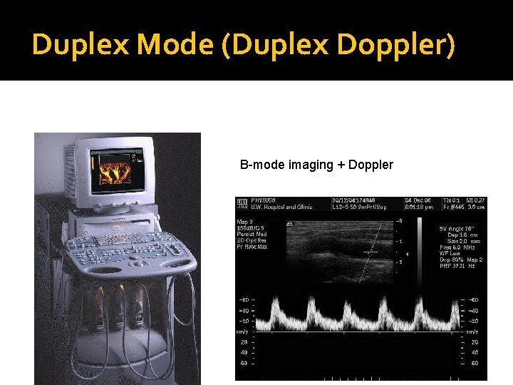 Duplex Mode (Duplex Doppler) B-mode imaging + Doppler 