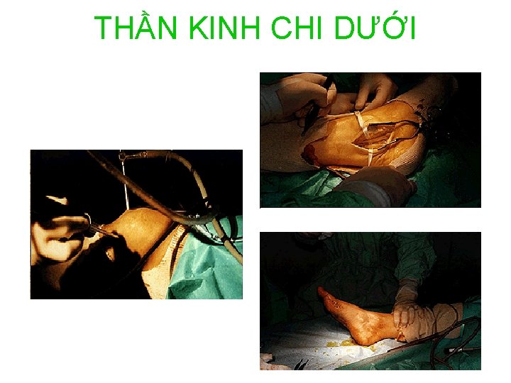 THẦN KINH CHI DƯỚI 