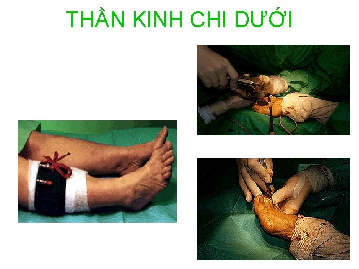 THẦN KINH CHI DƯỚI 