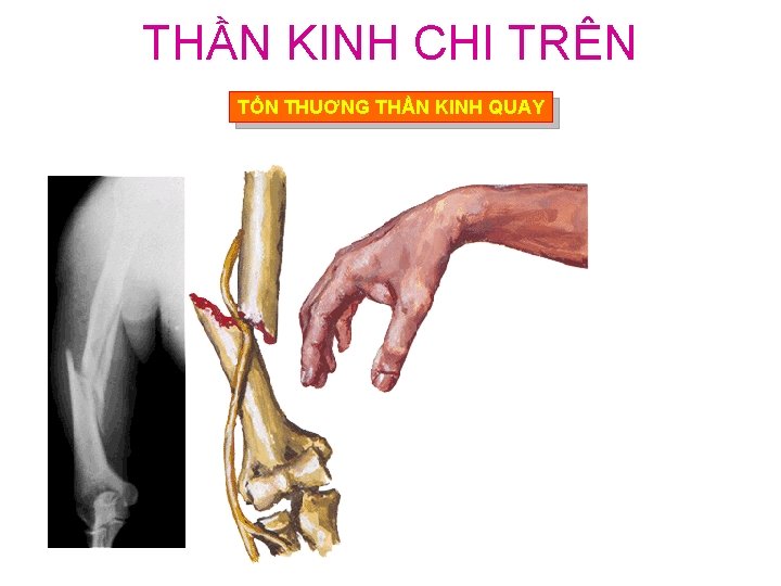 THẦN KINH CHI TRÊN TỔN THUƠNG THẦN KINH QUAY 