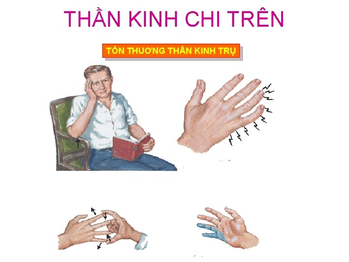 THẦN KINH CHI TRÊN TỔN THUƠNG THẦN KINH TRỤ 