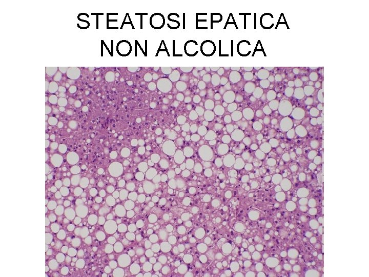 STEATOSI EPATICA NON ALCOLICA 