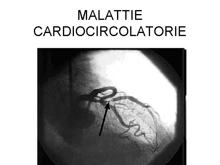 MALATTIE CARDIOCIRCOLATORIE 