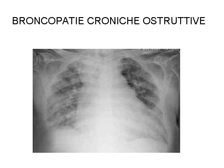 BRONCOPATIE CRONICHE OSTRUTTIVE 