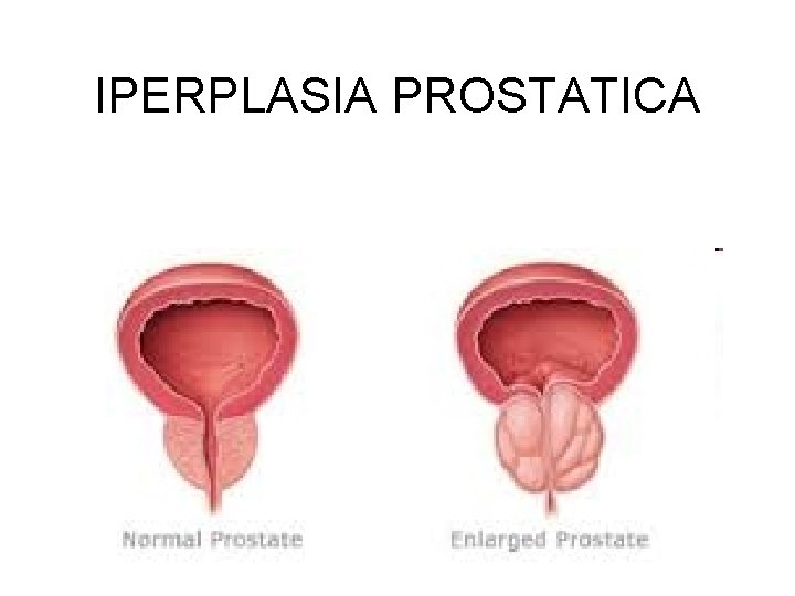 IPERPLASIA PROSTATICA 