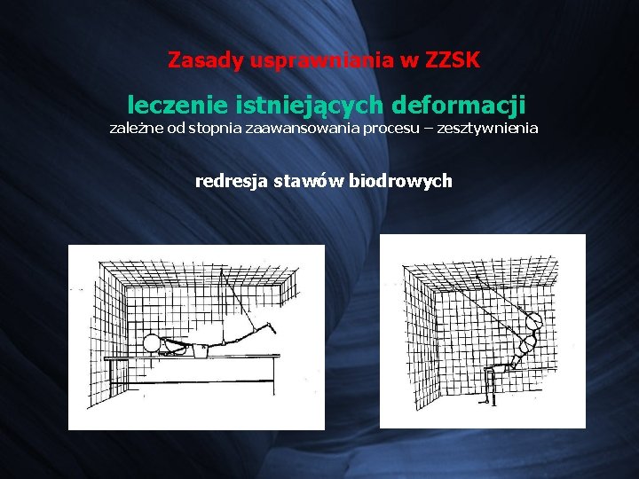 Zasady usprawniania w ZZSK leczenie istniejących deformacji zależne od stopnia zaawansowania procesu – zesztywnienia Zasady usprawniania w ZZSK leczenie istniejących deformacji zależne od stopnia zaawansowania procesu – zesztywnienia