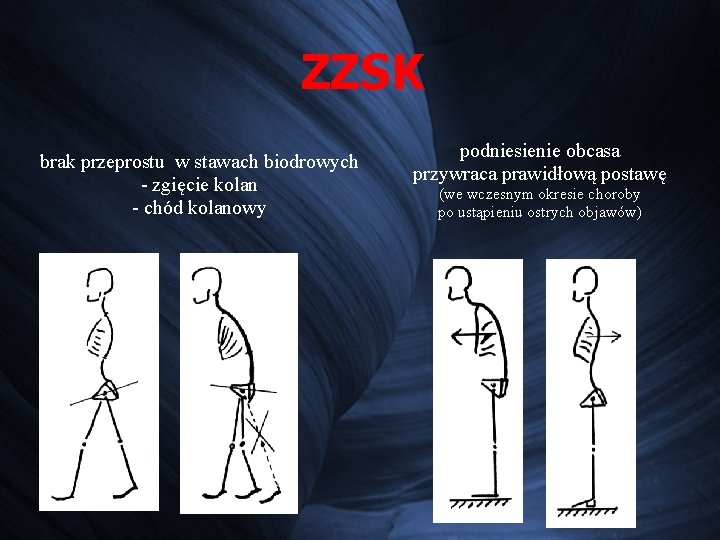 ZZSK brak przeprostu w stawach biodrowych - zgięcie kolan - chód kolanowy podniesienie obcasa ZZSK brak przeprostu w stawach biodrowych - zgięcie kolan - chód kolanowy podniesienie obcasa