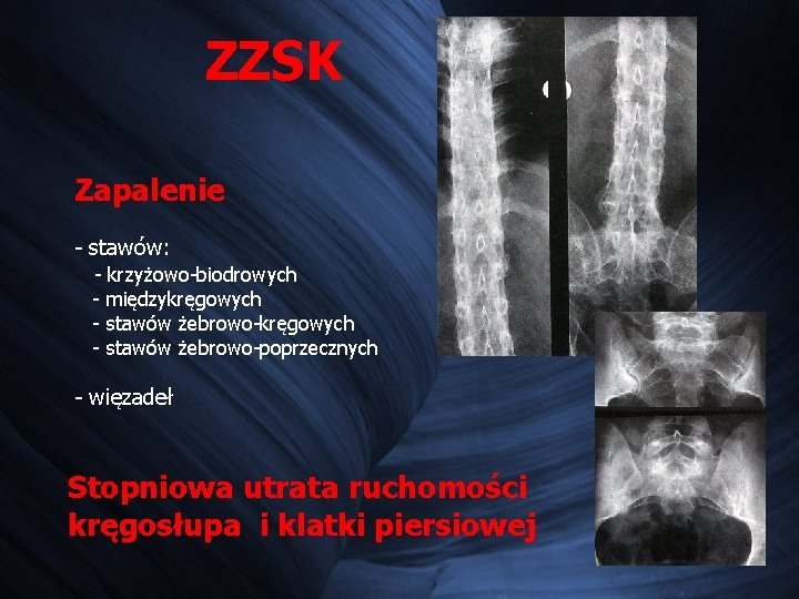 ZZSK Zapalenie - stawów: - krzyżowo-biodrowych - międzykręgowych - stawów żebrowo-poprzecznych - więzadeł Stopniowa ZZSK Zapalenie - stawów: - krzyżowo-biodrowych - międzykręgowych - stawów żebrowo-poprzecznych - więzadeł Stopniowa