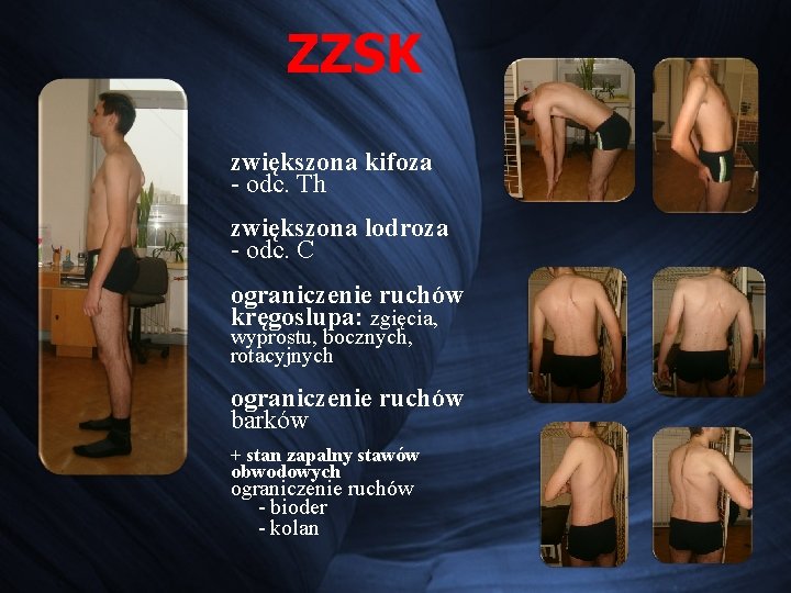 ZZSK zwiększona kifoza - odc. Th zwiększona lodroza - odc. C ograniczenie ruchów kręgoslupa: ZZSK zwiększona kifoza - odc. Th zwiększona lodroza - odc. C ograniczenie ruchów kręgoslupa: