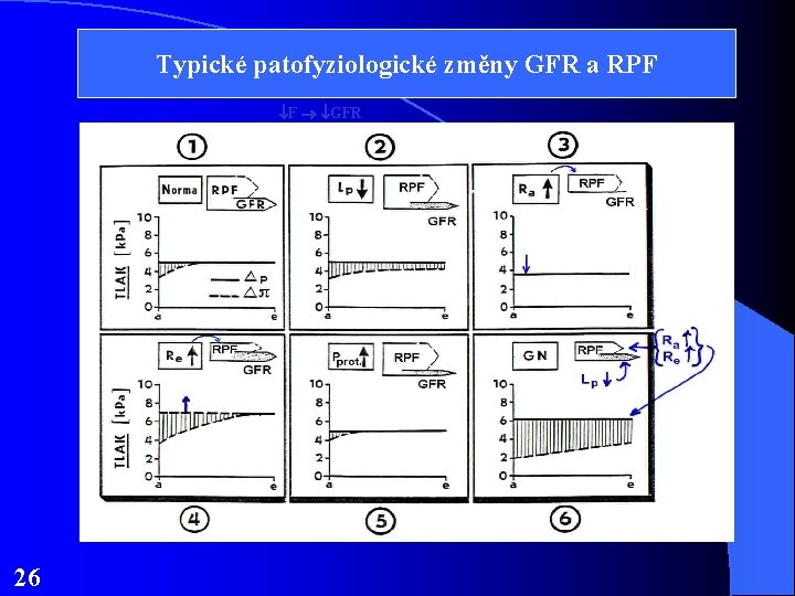 Typické patofyziologické změny GFR a RPF F GFR 26 Typické patofyziologické změny GFR a RPF F GFR 26