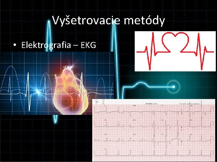 Vyšetrovacie metódy • Elektrografia – EKG 