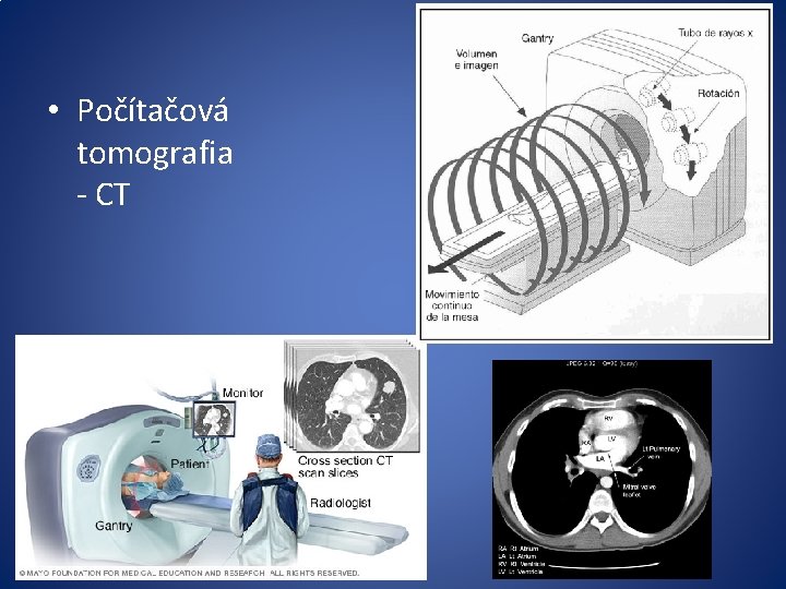  • Počítačová tomografia - CT 