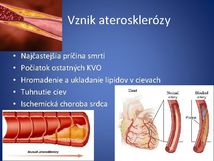  Vznik aterosklerózy • • • Najčastejšia príčina smrti Počiatok ostatných KVO Hromadenie a